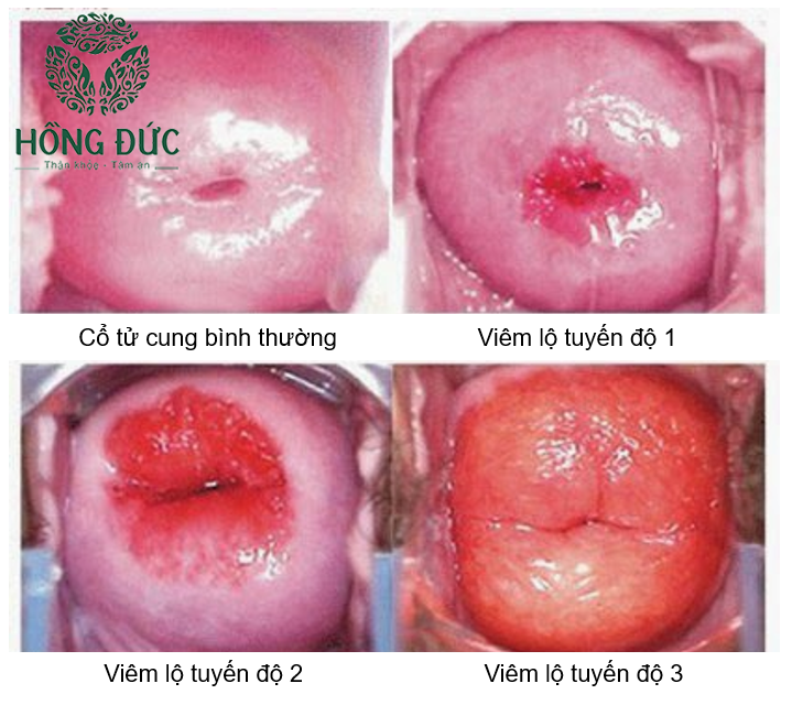 Viêm lộ tuyến cổ tử cung cấp độ 3 diện rộng - Hỏi đáp bác sĩ ...