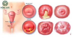 Viêm cổ tử cung các cấp độ từ mãn tính đến cấp tính, từ nhẹ đến nặng